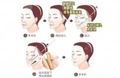 小切口拉皮手术恢复图分享，重回年轻美肌，自信看得见~