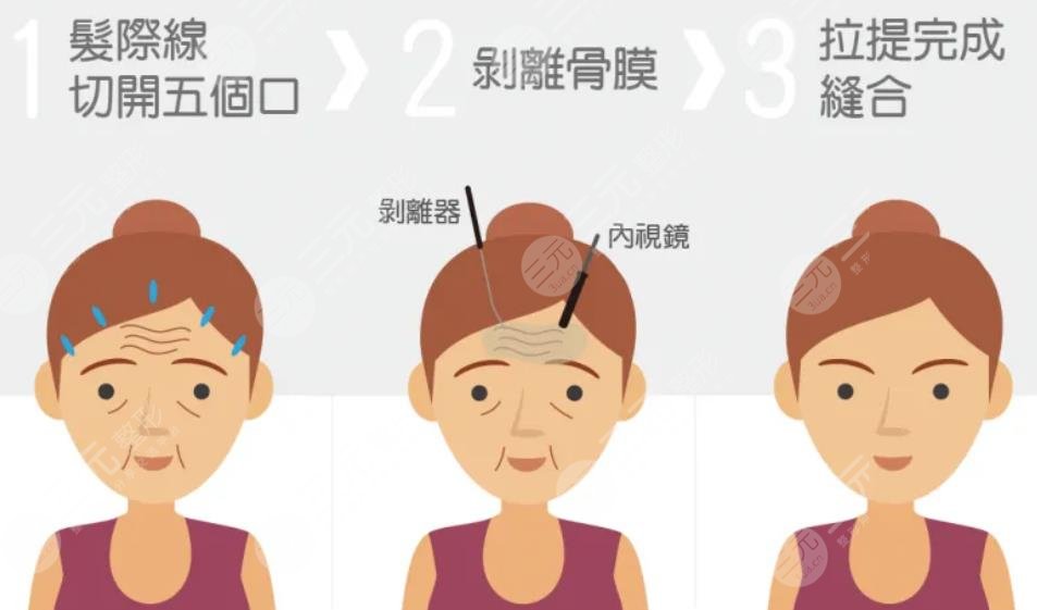 脸部拉皮手术全过程
