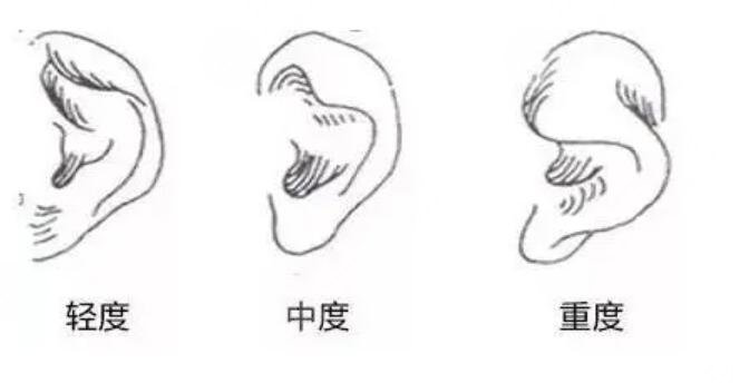 杯状耳整形适合人群
