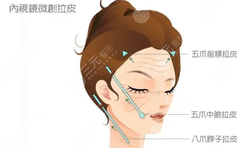 美容拉皮手术需要多少钱呢