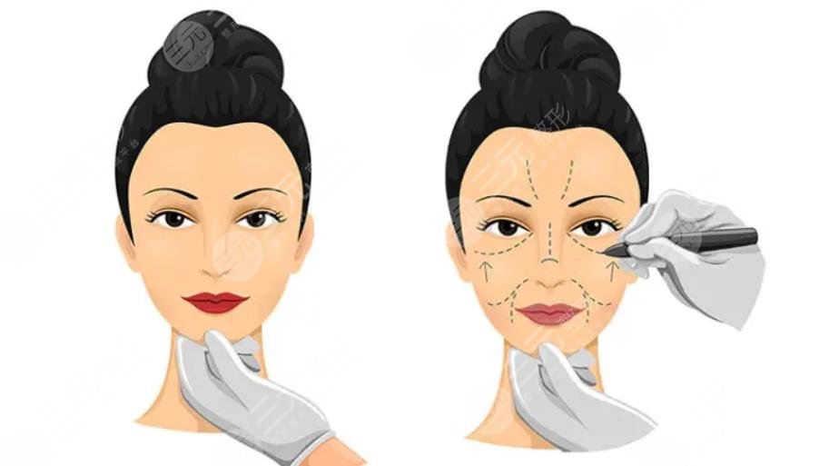 小拉皮手术可以维持多久