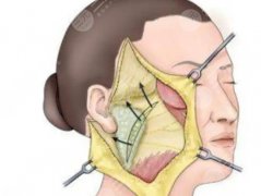 小拉皮手术多少钱一次？超全科普知识来袭，附3家知名整形机构