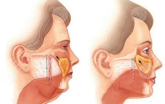 大拉皮手术15天照片