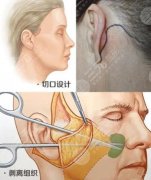 做小拉皮手术需要多少钱？盘点价格影响因素、注意事项、医院介绍