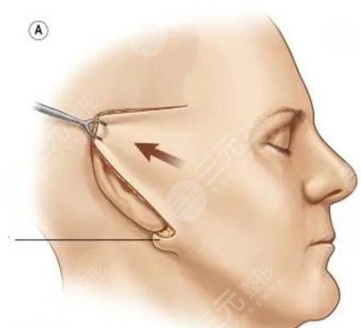 面部拉皮手术能维持几年