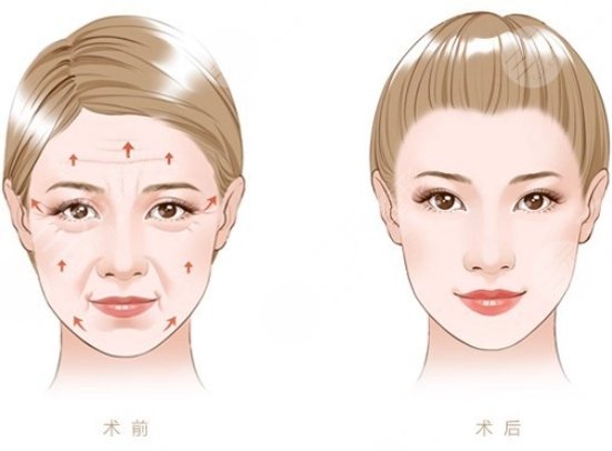 电波拉皮的功与作用是什么