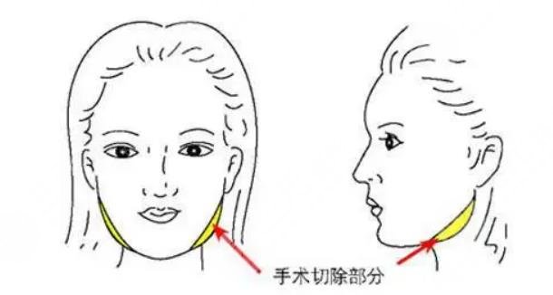 华西和友谊磨骨哪个贵