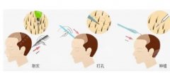 小榄人民医院整形科可以做植发吗?医院信息介绍&附带植发价格表一览! 小榄人民医院整形科可以做植发吗?医院信息介绍&附带植发价格表一览!