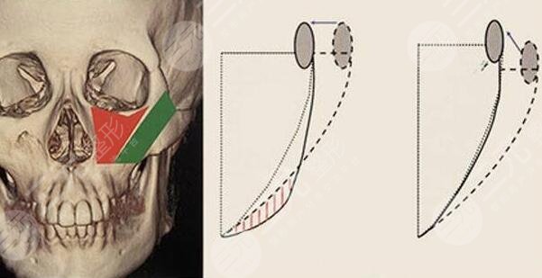 磨颧骨有风险吗？