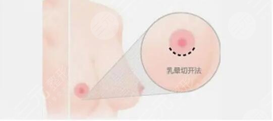 妙桃琴面假体隆胸优势