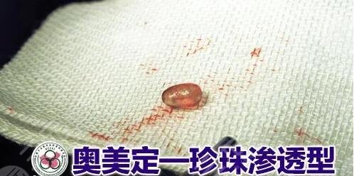 奥美定取出价格大概需要多少