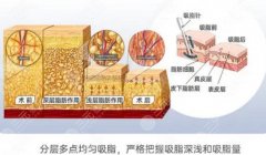 上海第九人民医院吸脂果如何？价目表分享&吸脂信息科普！