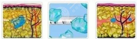 面部吸脂