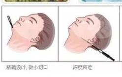 面部吸脂