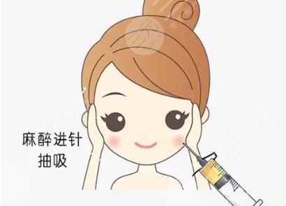 面部吸脂