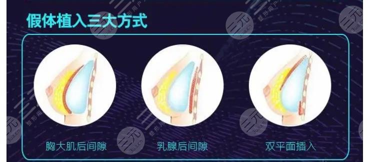 傲若拉假体?