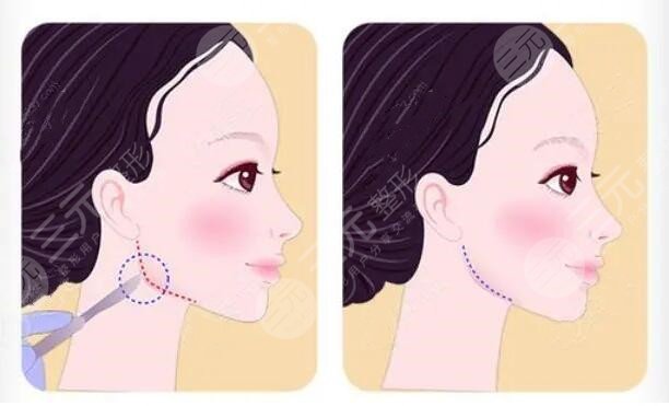 女士肥胖下颌角整形注意事项