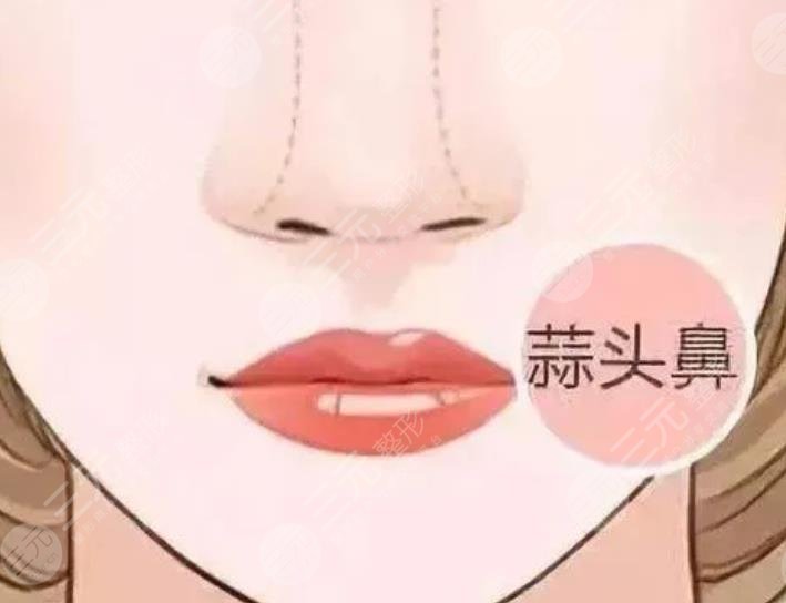 蒜头鼻缩小手术多少钱