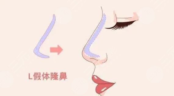 隆鼻后需要注意些什么