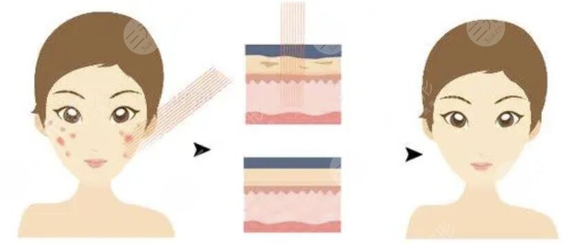 点阵激光后恢复过程图