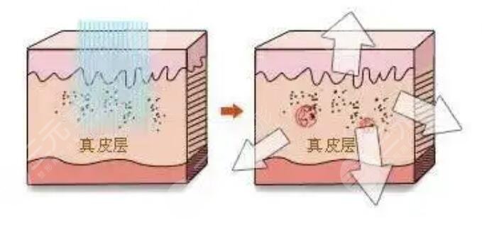 点阵激光后恢复原理
