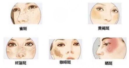 激光祛斑之后的护理措施有哪些呢?