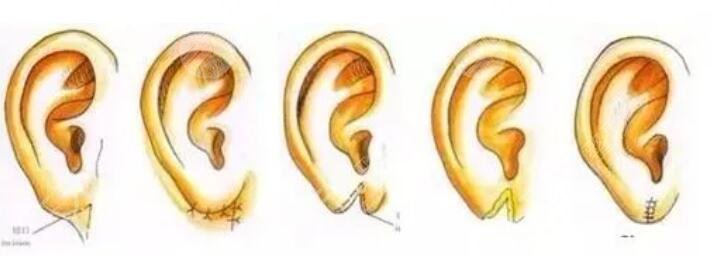 杯状耳整形