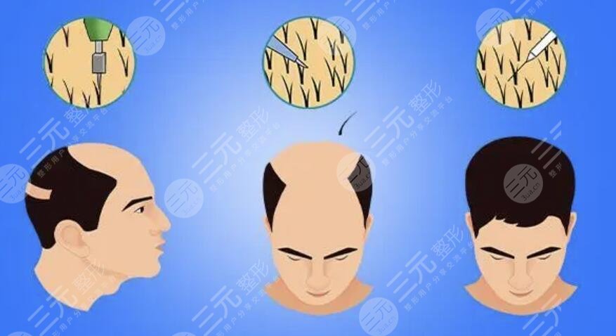 植发失败的原因