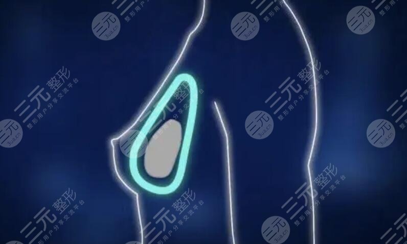 娜绮丽隆胸术后注意事项