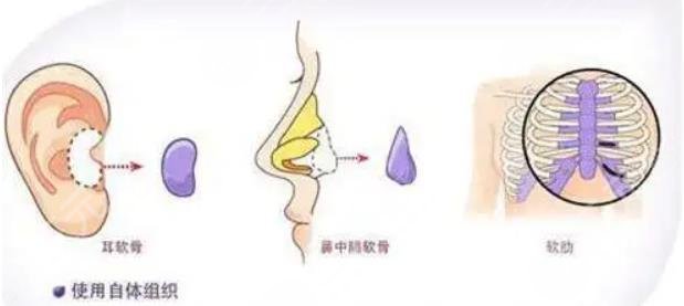 自体软骨隆鼻有哪些优缺点