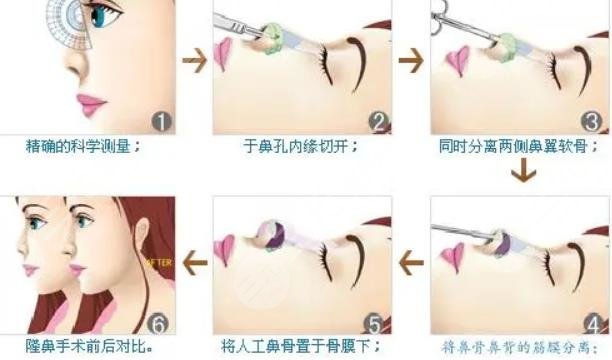 自体软骨隆鼻有哪些优缺点