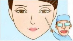 全切双眼皮1个月案例分享！术后果图反馈|价格表|医院介绍