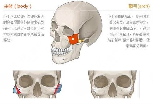 磨颧骨手术有什么风险和后遗症