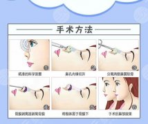 综合隆鼻前后对比果图曝光|1-90天恢复过程:轮廓自然不夸张~