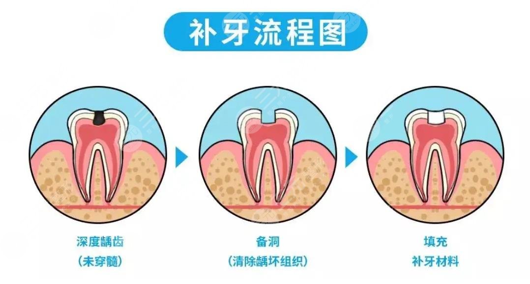 补牙多少钱一颗牙?2022价格表全新上线