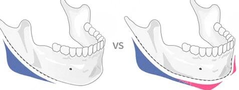 V-line瓜子脸的优势