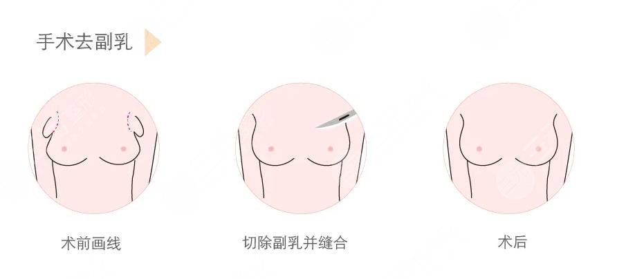 副乳切除