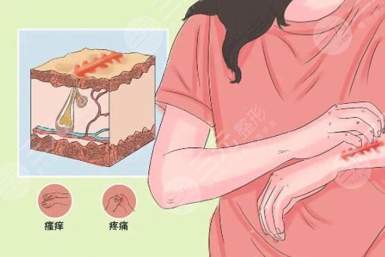 东莞人民医院整形科疤痕修复案例