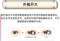 开外眼角图片前后对比分享!魅惑双眼get日记,附3家靠谱医美介绍~ 开外眼角图片前后对比分享!魅惑双眼get日记,附3家靠谱医美介绍~