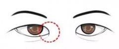开眼角对比果图来袭!小眼睛逆袭必看~附3家热门眼整形医院! 开眼角对比果图来袭!小眼睛逆袭必看~附3家热门眼整形医院!
