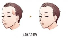 全脸脂肪填充5到10天照片公开!面填经验|热门医院|价格表,超全干货! 全脸脂肪填充5到10天照片公开!面填经验|热门医院|价格表,超全干货!