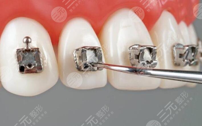 维乐口腔正畸科普