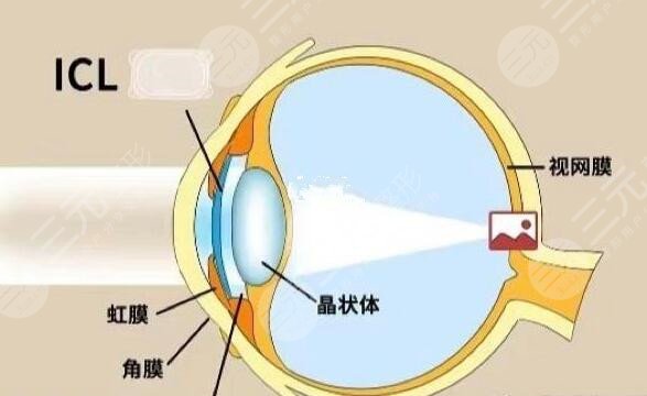 激光缓解近视眼要注意什么?