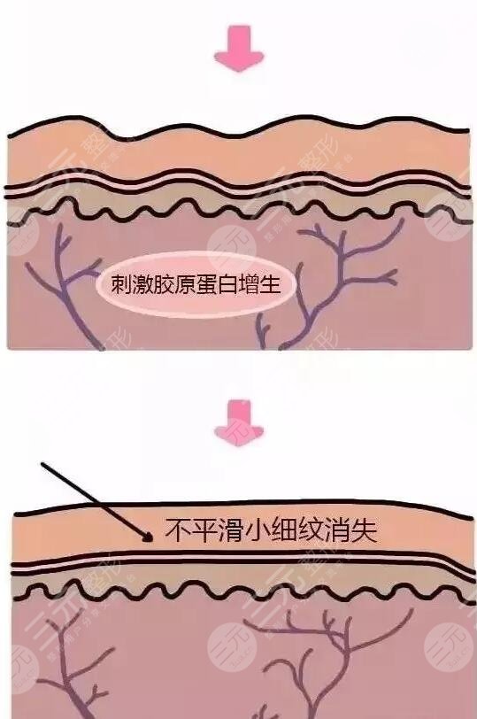 不同的操作员影响力冰电波拉皮的价格
