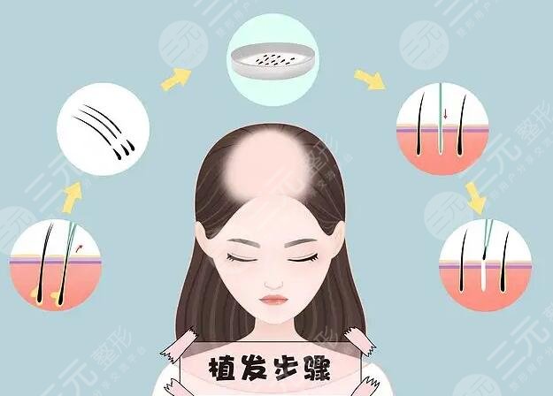 植发手术10元20元区别大吗?