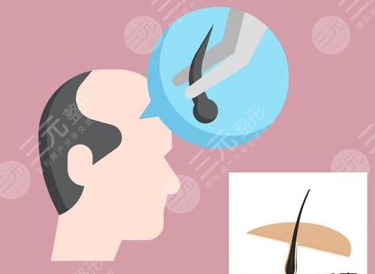 植发手术怎么操作?