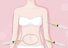 国内抽脂多少钱？正规医院价格收费详解！大腿、腰腹、全身吸脂分门别类~