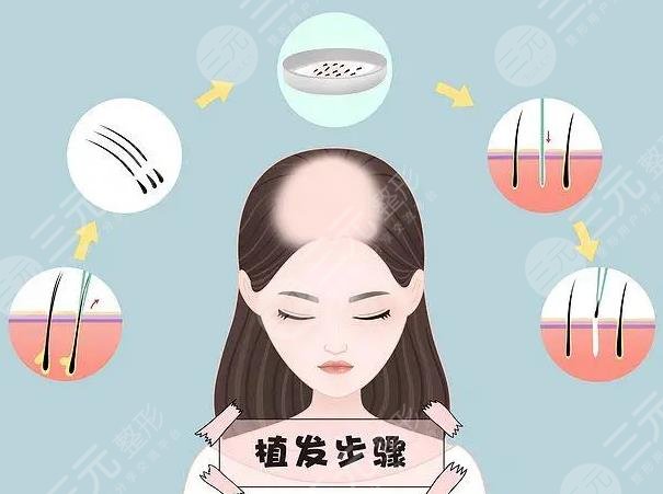 开封第二人民医院植发可以去开展吗