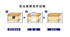 激光祛斑三天后的照片曝光!网友真实案例_光疗美容整形医院排名~ 激光祛斑三天后的照片曝光!网友真实案例_光疗美容整形医院排名~