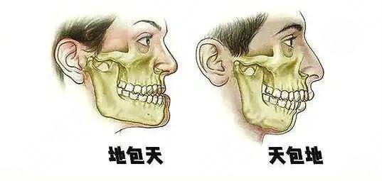 天包地矫正后脸型变化图共享，矫正前的“如花”，矫正后的“侧颜女神”~